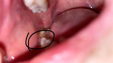 Image result for Cyst Extraction Videos