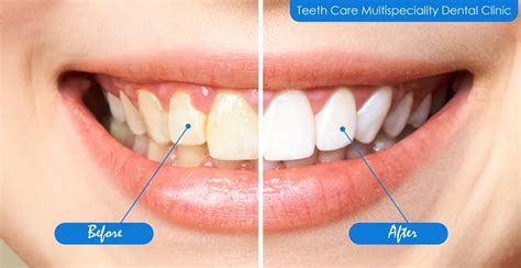 Best Laser Teeth Whitening in Kolkata | Teeth whitening cost