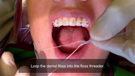 Image result for Using a Floss Threader