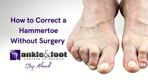 Non-Surgical Treatment Options for Hammertoe