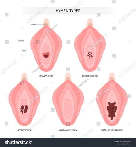 Imperforate Hymen Repair
