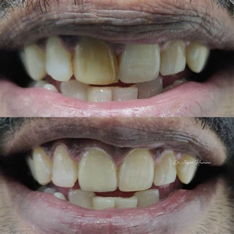 Dental Crowns And Bridges In Noida – Best Dental Clinic In Noida | Top Dentist In Noida