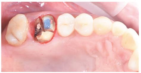 The Use of Vacuum Plasma Surface Treatment to Improve Bone Healing and ...