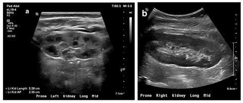 Imaging Diagnosis of Major Kidney and Urinary Tract Disorders in Children