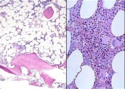 16 aplastic anemia patients free of disease after bone marrow ...