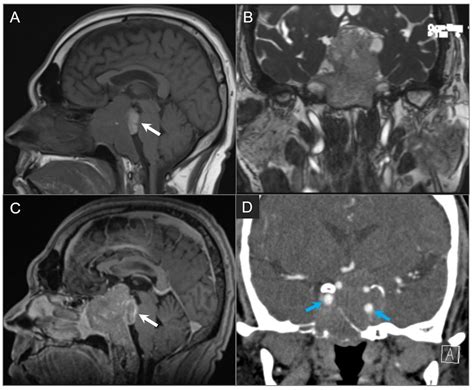 Imaging of Skull Base Tumors