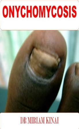 Dermatology: Onychomycosis or Fungal Nail Infection (Nail Diseases Book ...