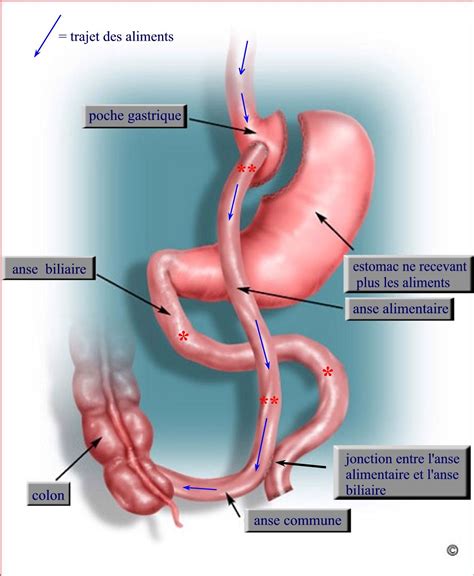 Le bypass gastrique - Chirurgie-Digestive.com - Docteur Paul Lachowsky ...