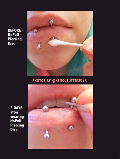 Hypertrophic Scar Nose Piercing