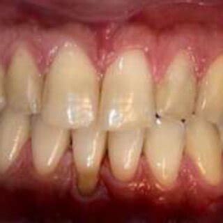 Tooth Recession 的图像结果