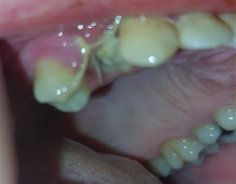 What's this white stuff in my tooth extraction hole? Is it healing OK ...