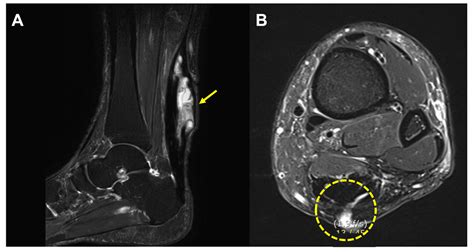 Clinical Features and Treatment of Intra-Tendinous Suture Reaction ...