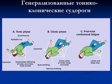 Хроническое заболевание головного мозга эпилепсия. Классификация ...
