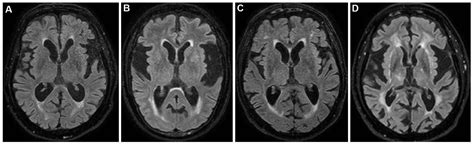 Dementia-Associated Compulsive Singing (DACS): Presentation of ...