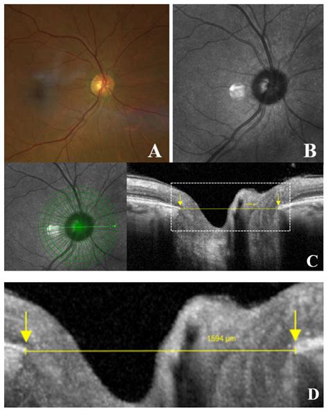 Interpupillary Distance and Peripapillary Myopic Changes: A Pilot Study ...