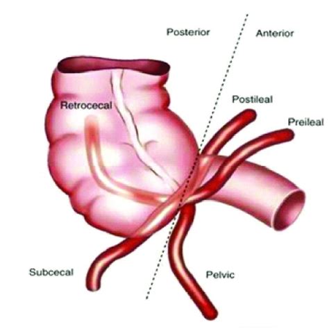 Image result for Appendix Variants