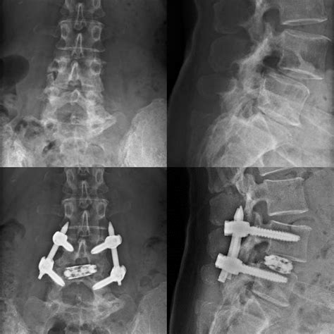 Single-Level Endoscopic TLIF Has Decreased Surgery Duration, Blood Loss ...