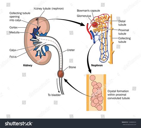 Drawing To Show The Formation Of A Kidney Stone, With Detail Of Crystal Formation In Nephron And ...