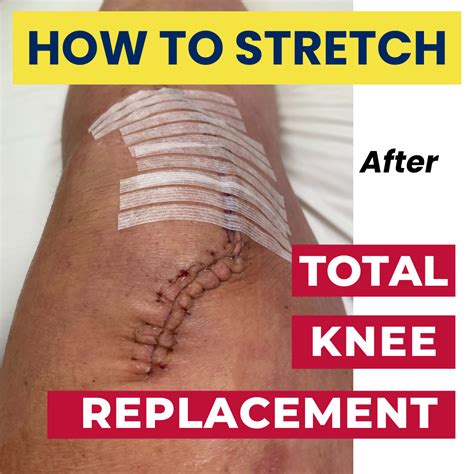 Image result for Total Knee Replacement Exercise Program