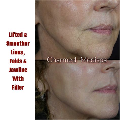 Sculpt And Define The Jawline And Improve Jowls – Charmed Medispa