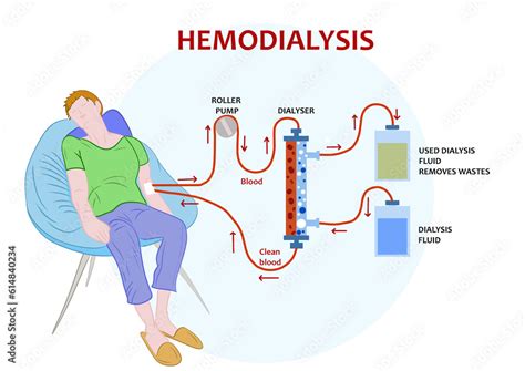 Image result for Dialysis Procedure Step by Step