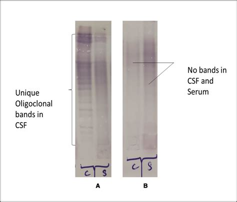 Evaluation of CSF kappa free light chains for the diagnosis of multiple ...
