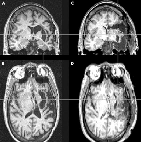 Aphasia after hemispherectomy in an adult with early onset epilepsy and hemiplegia | Journal of ...