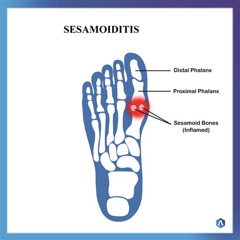 Sesamoiditis | Dr. Abbie Clinics