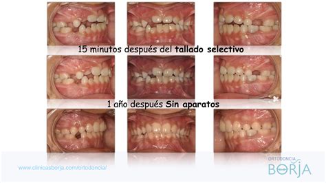Ortodoncia Borja | Cuando los brackets no son la solución