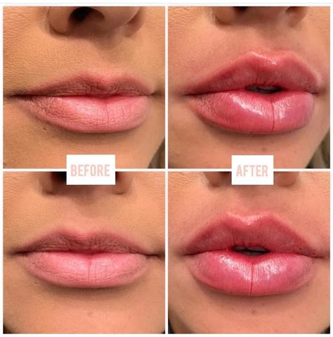 Dermal Fillers Lips, Botox Fillers, Lip Fillers, Lip Injections Juvederm, Botox Lips, Juviderm ...