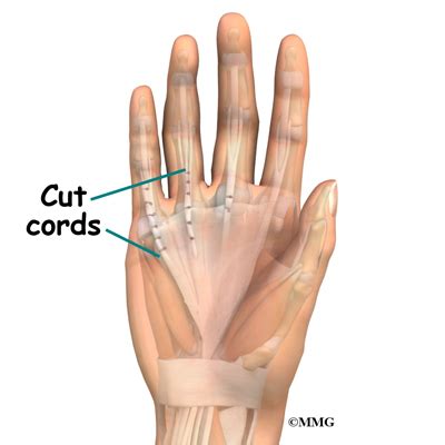 Bildergebnis für dupuytren's surgery pictures