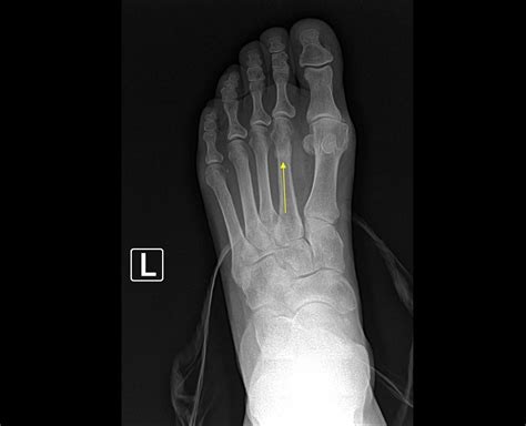 Top of foot hairline fracture - lokicj