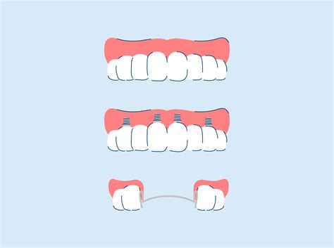 Image result for Different Types Dentures