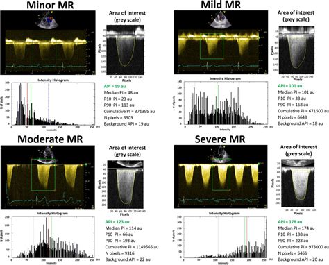 Grading of mitral regurgitation based on intensity analysis of the continuous wave Doppler ...