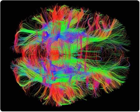 Image result for Diffuse Tensor Imaging
