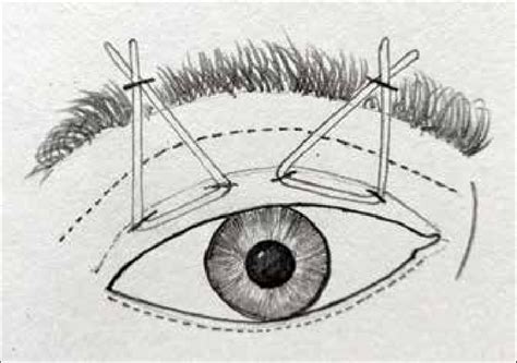 Image result for Mehta Method Tutorial