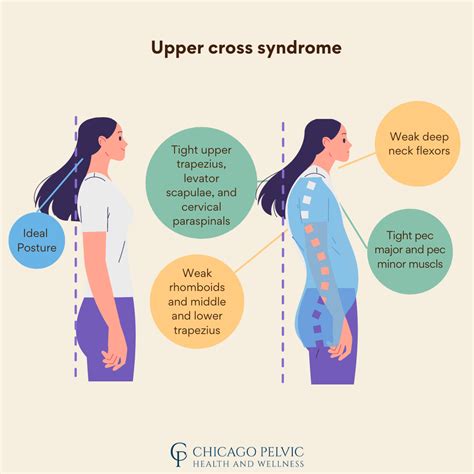 Upper Cross Syndrome Headaches What Is Upper Cross Syndrome? | El