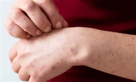 Tree Man Disease: शरीर के अंगों में उभरने लगती है पेड़ों के तने की तरह ...