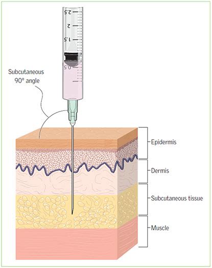 Image result for Subcut Injection OSCE