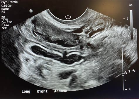 Appendicitis seen on transvaginal ultrasound : r/Radiology