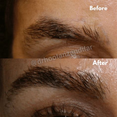 Eyebrow Transplant Procedure Beverly Hills and Los Angeles CA