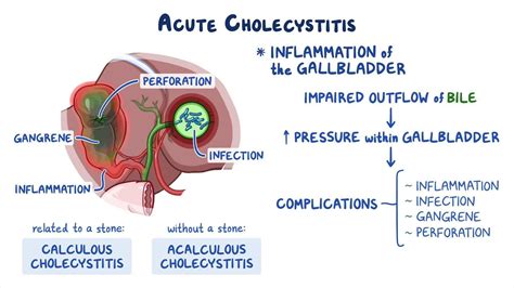 Cholangitis Vs Cholecystitis Cholecystitis Vs Choledocholithiasis Vs