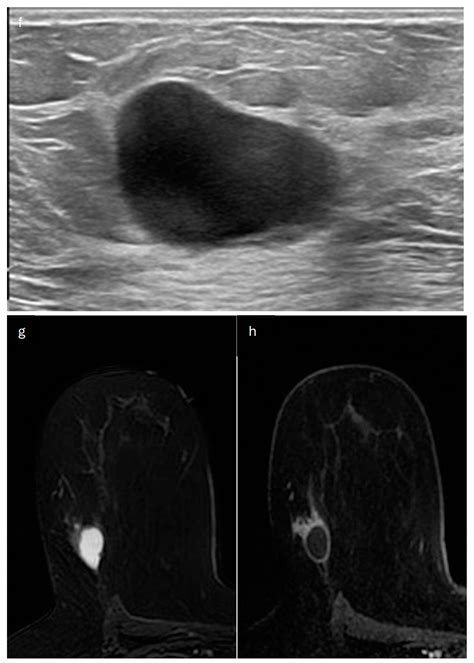 Special Types of Breast Cancer: Clinical Behavior and Radiological ...
