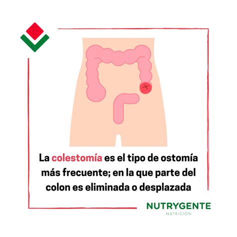 Ostomía: tipos de colostomía y dieta - Nutrygente