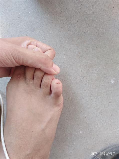 那些小脚趾指甲长成两瓣的人，到底是什么来头？ - 知乎