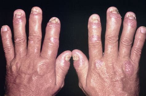 Herbal Psoriasis Treatment & Counselling Clinic