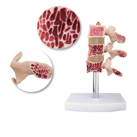 CUT AWAY OSTEOPOROSIS MODEL – Medilab India