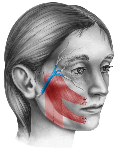 ¿Qué es el signo de Bell? - Parálisis facial en Monterrey