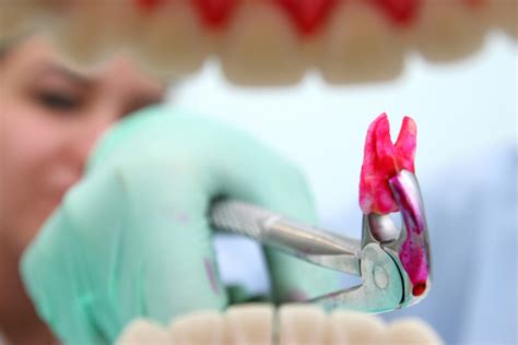 Image result for Pulled Tooth