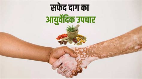 Home remedies for white spot swami ramdev share ayurvedic remedies to ...